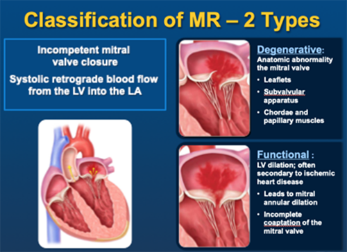 severe-mitral-regurgitation-with-normal-lv-size-iucn-water