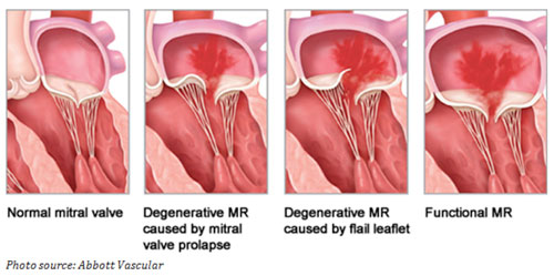 What Is The Most Common Cause Of Mitral Regurgitation