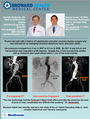 Stenting of Abdominal Aortic Aneurysms (AAA)