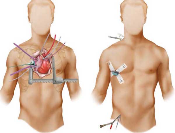 mitral-valve-repair-replacement